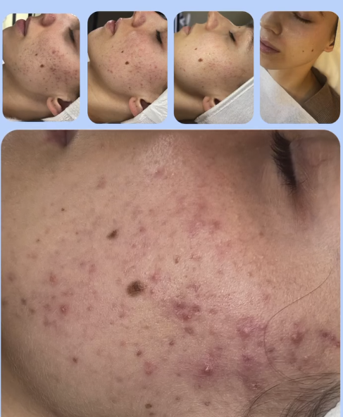 Acne and Post Acne treatment on patient in dubai inskin aesthetic clinic