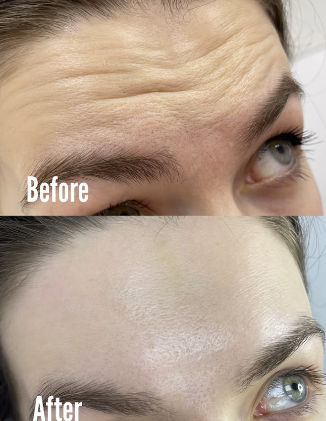 Botox injection anti wrinkle treatment for forehead lines on patient in dubai inskin aesthetic clinic