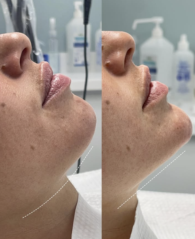 Jawline contouring and jaw filler on patient in dubai inskin aesthetic clinic