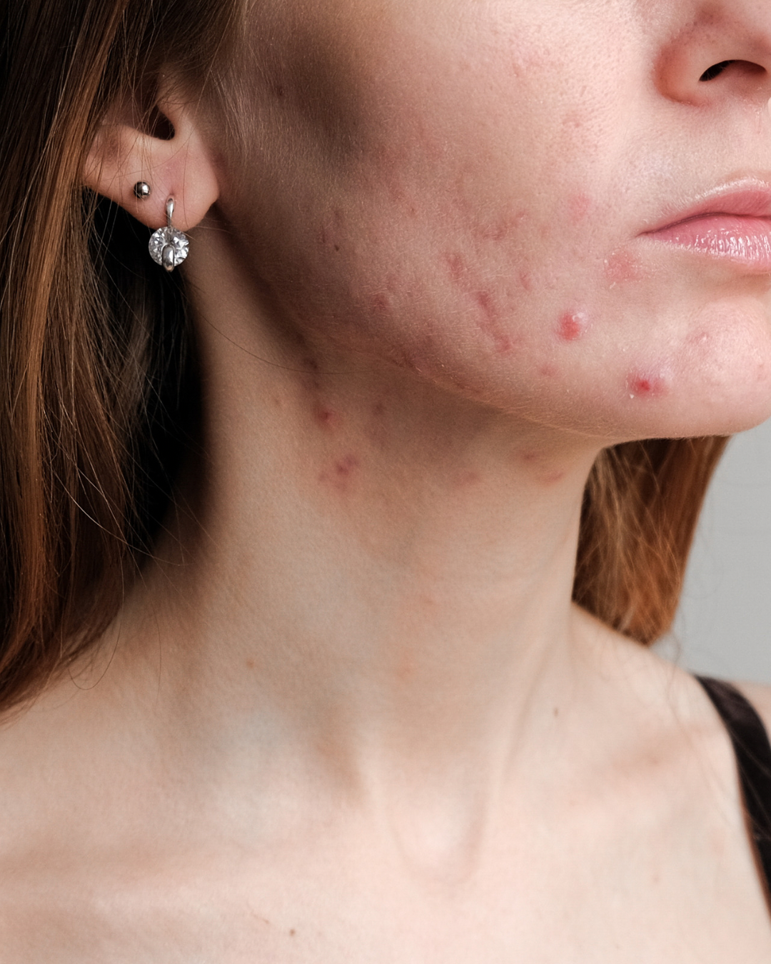 Acne treatment and post acne scars reduction in dubai at inskin aesthetic clinic.
