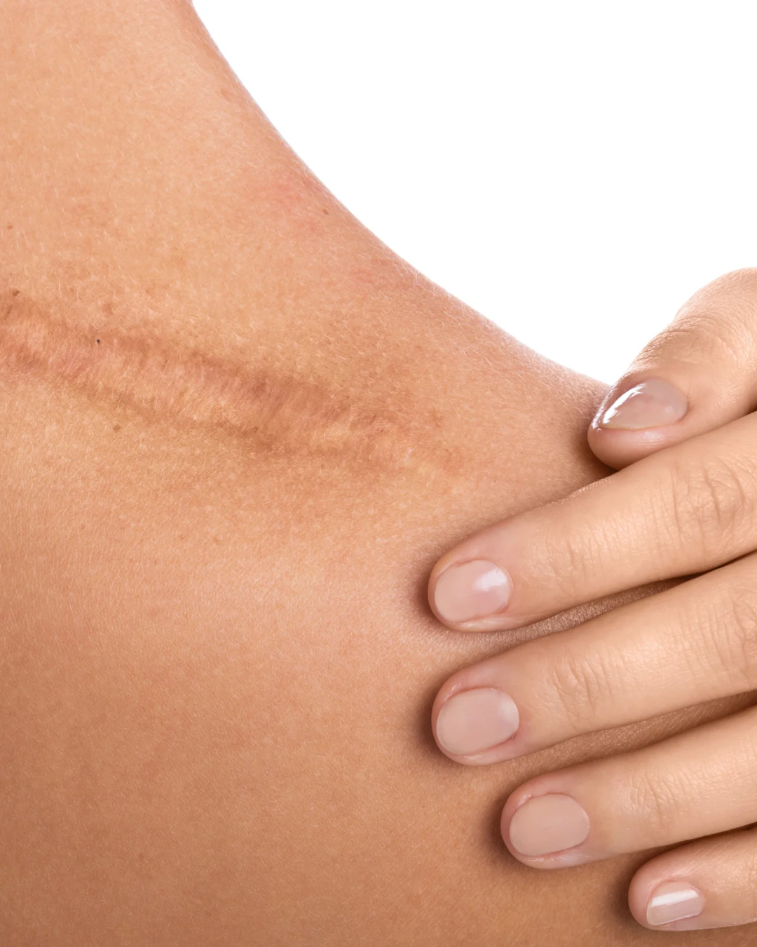 CO2 laser skin resurfacing treatment in dubai