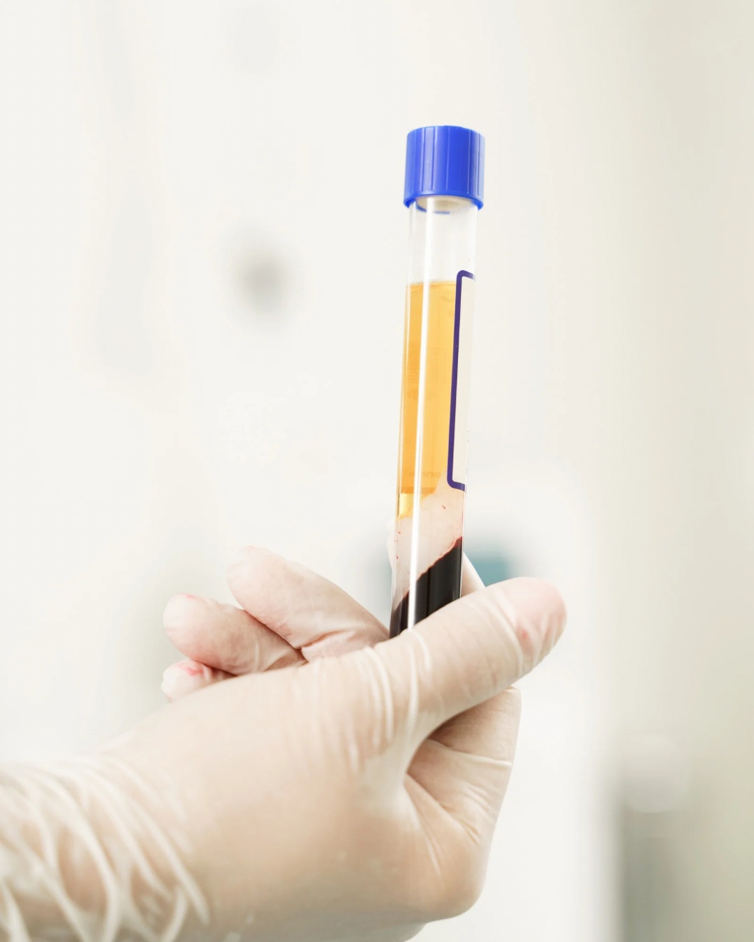 PRP Treatment for face in dubai.